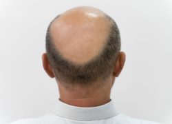 homem-corajoso-precisando-de-uma-extracao-de-unidade-folicular homem-corajoso-precisando-de-uma-extracao-de-unidade-folicular